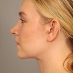 Mini Neck Lift (Single Incision) Before & After Patient #1690