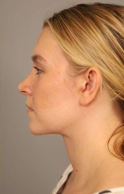 Mini Neck Lift (Single Incision) Before & After Patient #1690