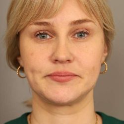 Neck Liposuction / Chin Liposuction Before & After Patient #1703
