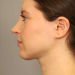 Neck Liposuction / Chin Liposuction Before & After Patient #1712