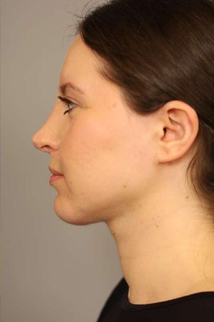 Neck Liposuction / Chin Liposuction Before & After Patient #1712