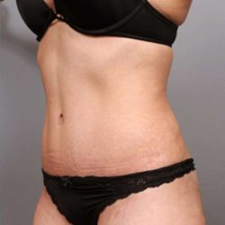 Tummy Tuck Before & After Patient #370