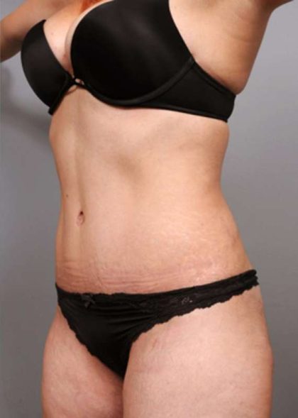 Tummy Tuck Before & After Patient #370