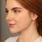 Neck Liposuction / Chin Liposuction Before & After Patient #1719