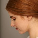 Neck Liposuction / Chin Liposuction Before & After Patient #1722
