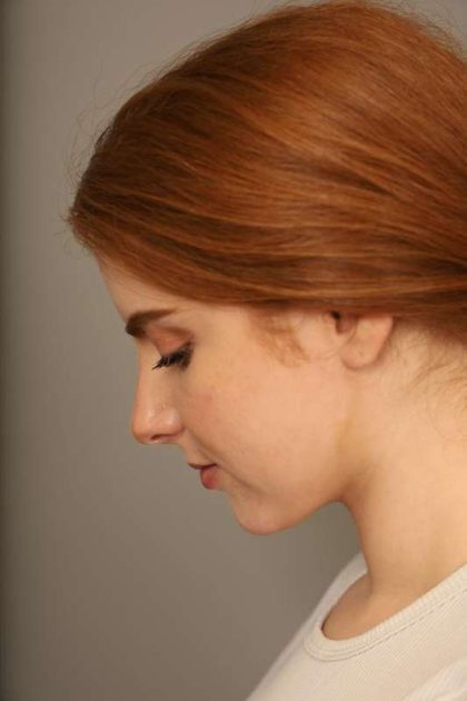 Neck Liposuction / Chin Liposuction Before & After Patient #1722