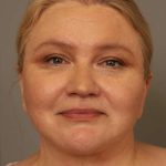 Neck Liposuction / Chin Liposuction Before & After Patient #1743
