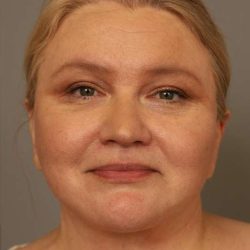 Neck Liposuction / Chin Liposuction Before & After Patient #1743
