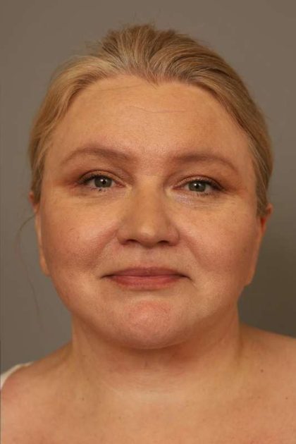 Neck Liposuction / Chin Liposuction Before & After Patient #1743