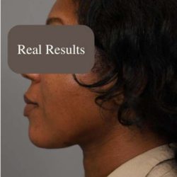 Neck Liposuction / Chin Liposuction Before & After Patient #1747