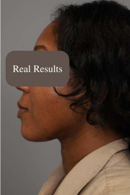 Neck Liposuction / Chin Liposuction Before & After Patient #1747