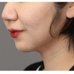 Neck Liposuction / Chin Liposuction Before & After Patient #1750