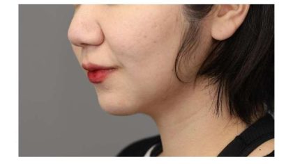 Neck Liposuction / Chin Liposuction Before & After Patient #1750