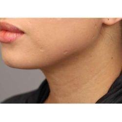 Neck Liposuction / Chin Liposuction Before & After Patient #1753