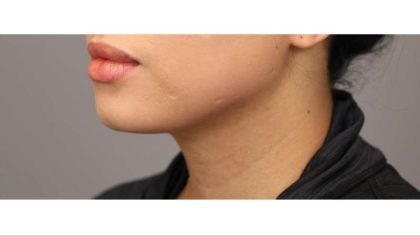 Neck Liposuction / Chin Liposuction Before & After Patient #1753