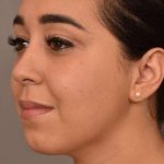 Neck Liposuction / Chin Liposuction Before & After Patient #1761