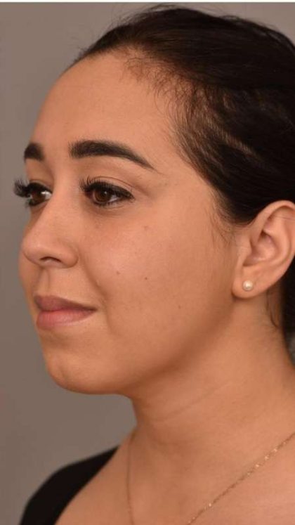 Neck Liposuction / Chin Liposuction Before & After Patient #1761