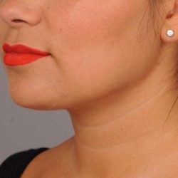 Neck Liposuction / Chin Liposuction Before & After Patient #1770