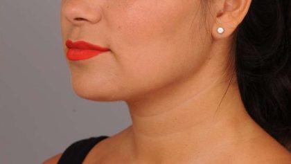 Neck Liposuction / Chin Liposuction Before & After Patient #1770