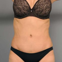 Tummy Tuck Before & After Patient #377