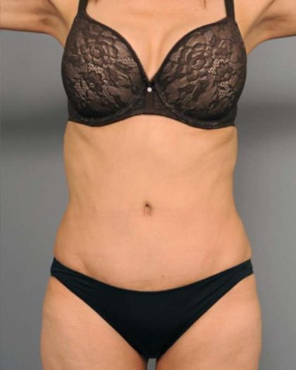 Tummy Tuck Before & After Patient #377