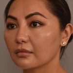 Neck Liposuction / Chin Liposuction Before & After Patient #1781