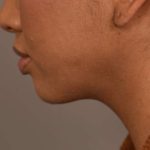 Neck Liposuction / Chin Liposuction Before & After Patient #1787