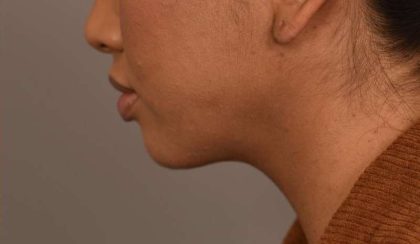Neck Liposuction / Chin Liposuction Before & After Patient #1787