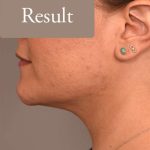 Neck Liposuction / Chin Liposuction Before & After Patient #1794