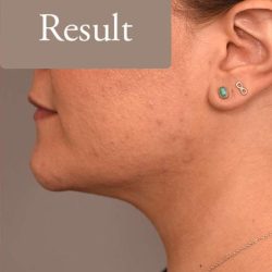 Neck Liposuction / Chin Liposuction Before & After Patient #1794