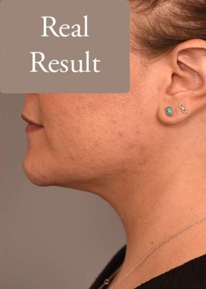 Neck Liposuction / Chin Liposuction Before & After Patient #1794