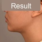 Neck Liposuction / Chin Liposuction Before & After Patient #1801