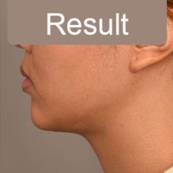 Neck Liposuction / Chin Liposuction Before & After Patient #1801
