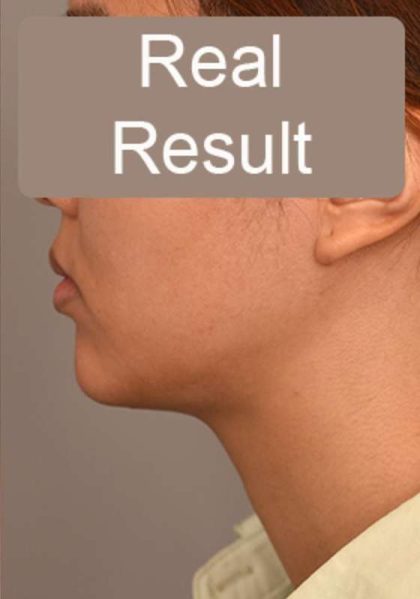 Neck Liposuction / Chin Liposuction Before & After Patient #1801