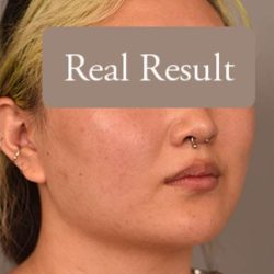 Neck Liposuction / Chin Liposuction Before & After Patient #1816