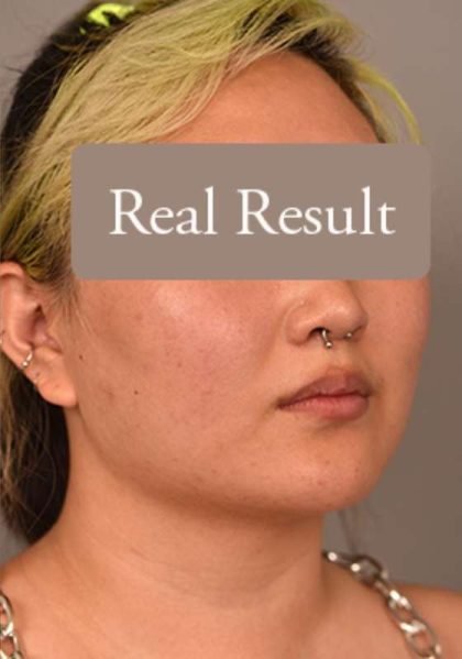 Neck Liposuction / Chin Liposuction Before & After Patient #1816