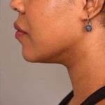 Neck Liposuction / Chin Liposuction Before & After Patient #1824