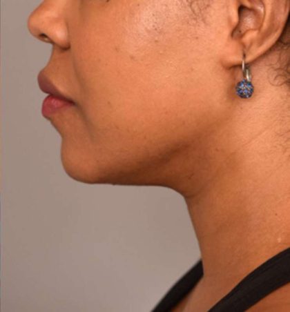 Neck Liposuction / Chin Liposuction Before & After Patient #1824