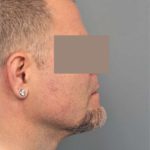Neck Liposuction / Chin Liposuction Before & After Patient #1831