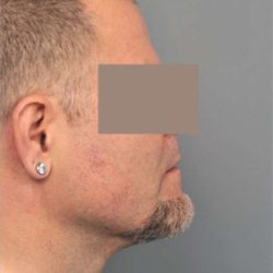 Neck Liposuction / Chin Liposuction Before & After Patient #1831