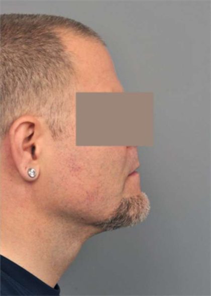 Neck Liposuction / Chin Liposuction Before & After Patient #1831