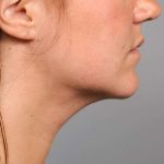 Neck Liposuction / Chin Liposuction Before & After Patient #1839