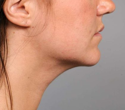 Neck Liposuction / Chin Liposuction Before & After Patient #1839