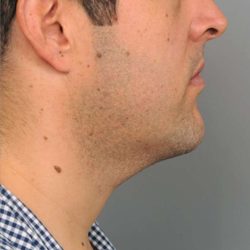 Neck Liposuction / Chin Liposuction Before & After Patient #1846