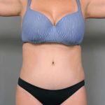 Tummy Tuck Before & After Patient #386