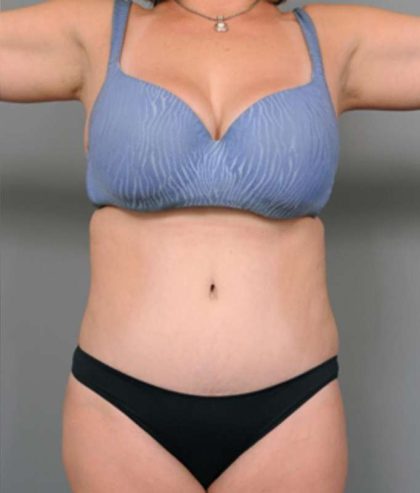 Tummy Tuck Before & After Patient #386