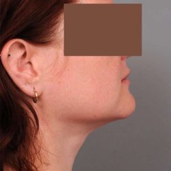 Neck Liposuction / Chin Liposuction Before & After Patient #1854