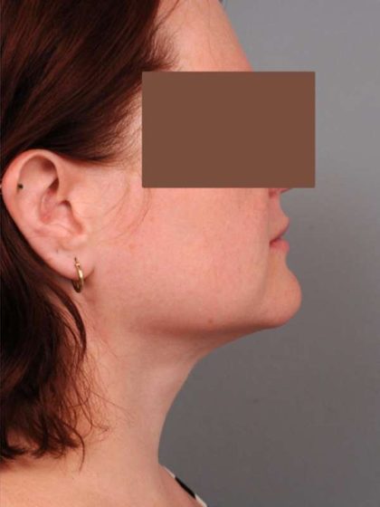 Neck Liposuction / Chin Liposuction Before & After Patient #1854