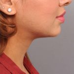 Neck Liposuction / Chin Liposuction Before & After Patient #1859