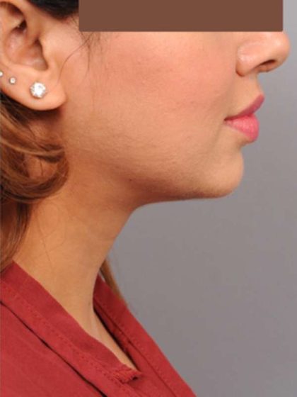 Neck Liposuction / Chin Liposuction Before & After Patient #1859